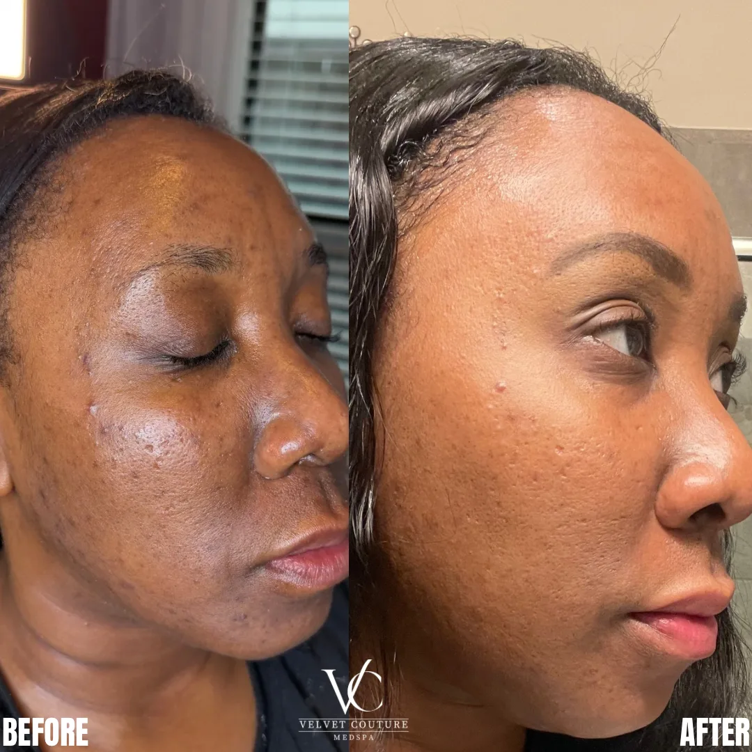 SkinPen Microneedling at Velvet Couture Medspa in Houston Heights
